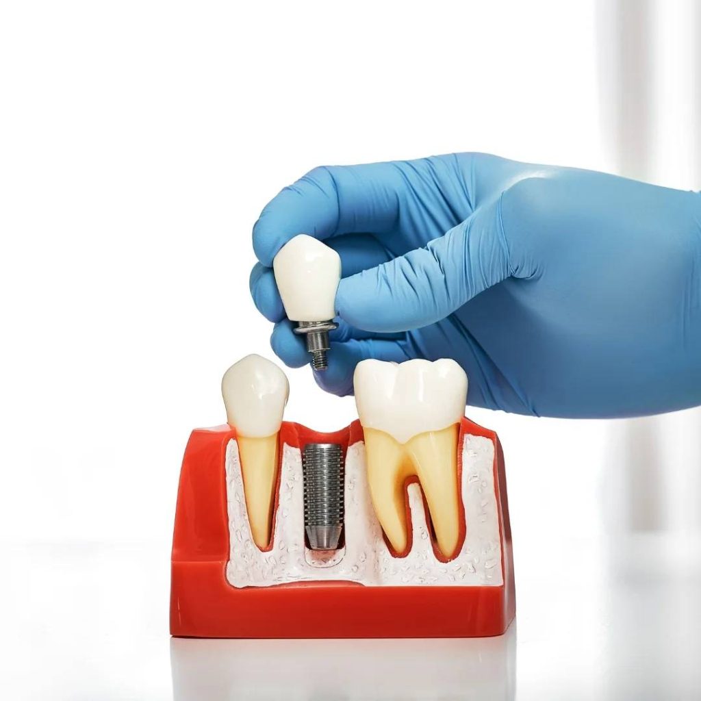 Implant Dentistry Owen Sound ON