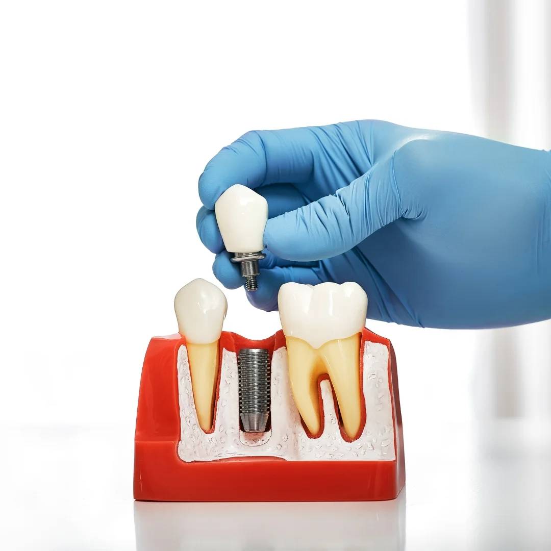 Implant Dentistry Owen Sound ON